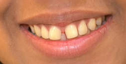 Antes